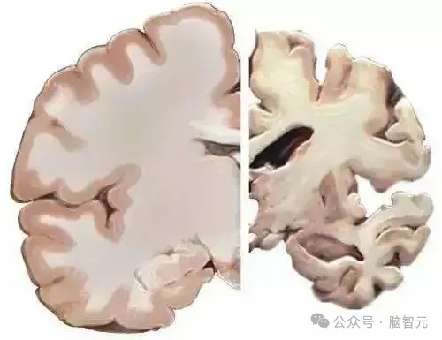 世界阿尔茨海默病日丨早筛查早干预，共享脑健康